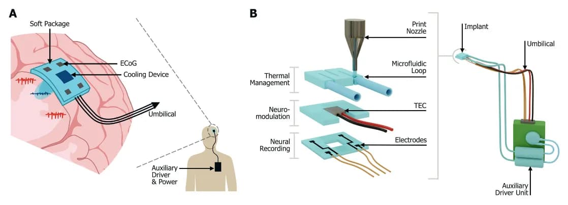 3Dプリントインプラントが薬剤耐性てんかんに新たな希望を提供